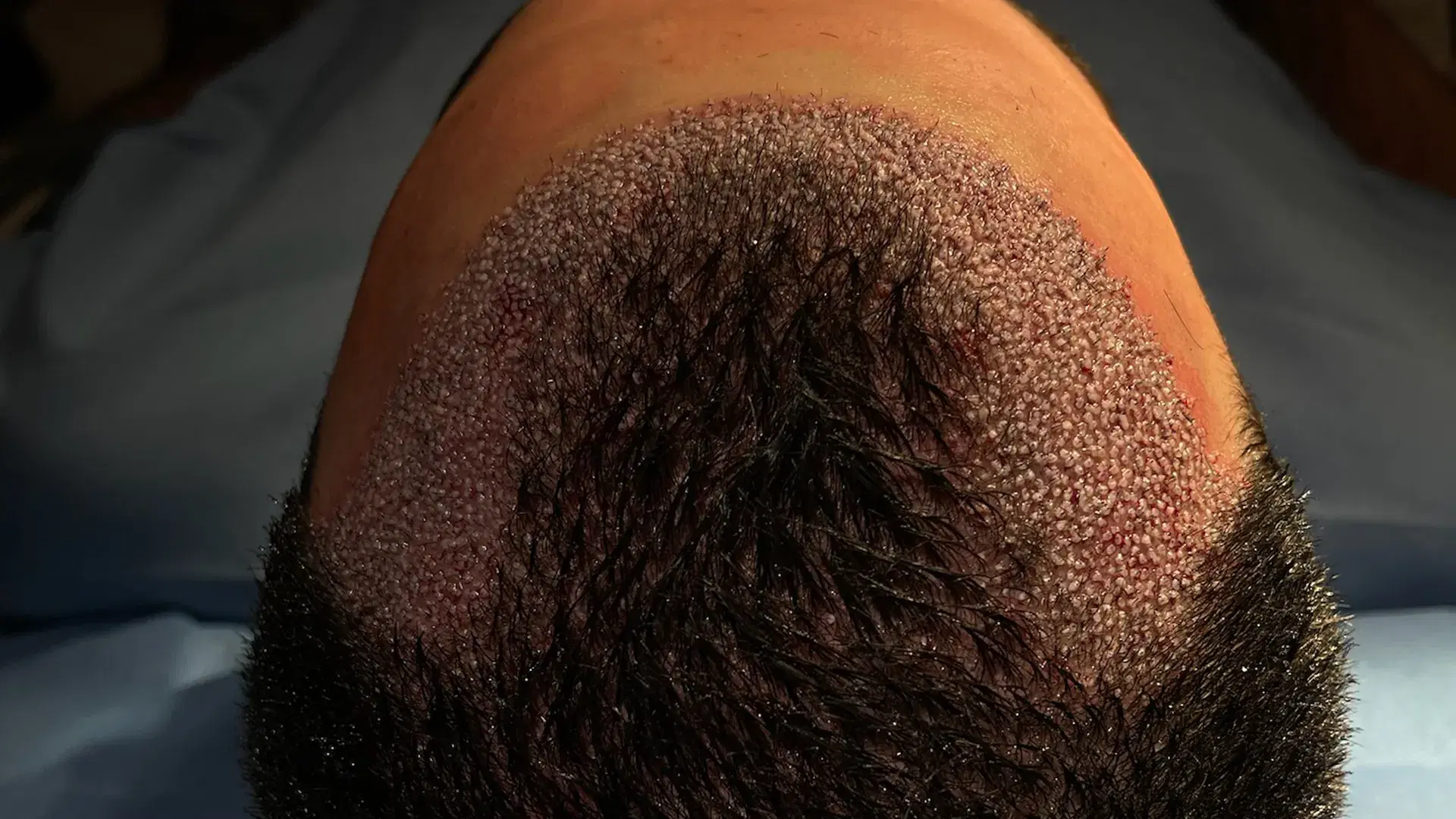 Is a No Shave Hair Transplant Painful?