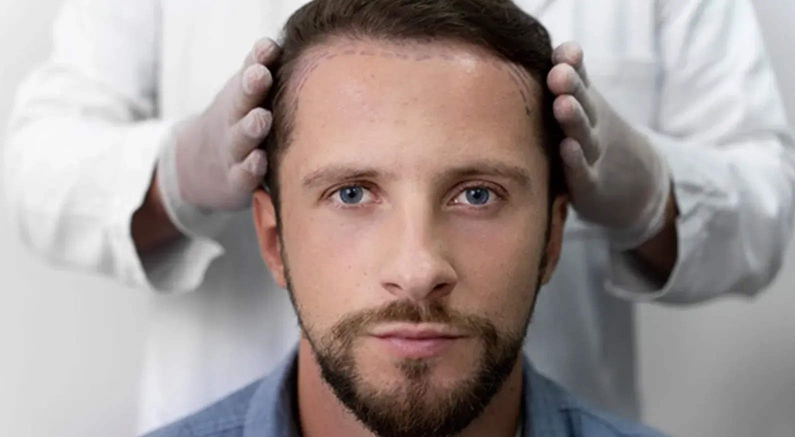 Unshaven Hair Transplant